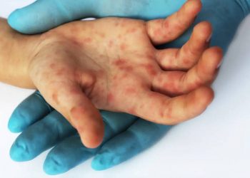 OMS declara viruela del mono como emergencia sanitaria de preocupación internacional