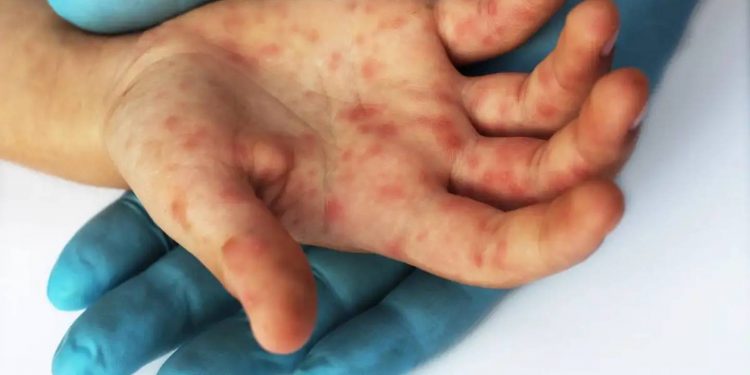 OMS declara viruela del mono como emergencia sanitaria de preocupación internacional